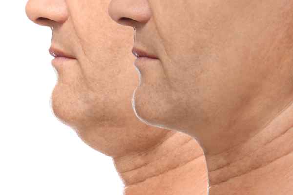 HIFU - Breakthrough in Anti - ageing 2 hifu results Hamilton