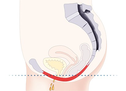 Pelvic-Floor Muscle Repair 5 Pelvic floor muscles Hamilton