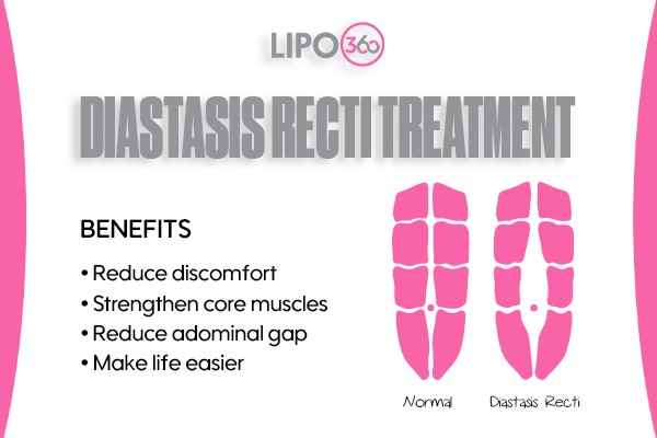 Revolutionising Muscle Repair: The Power of LIPO360 Body Sculpt Post-Injury 5 diastasis recti treatment Hamilton