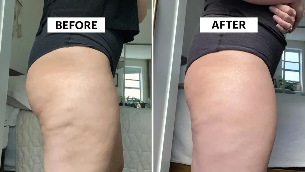Do Toning Exercise Hamilton Really Tackle Cellulite?