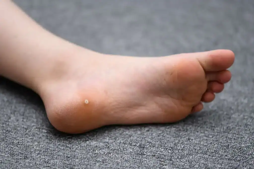 Cryotherapy For Warts And Also Verrucas 2 Image of verruca on the bottom of the foot that able to be treated with Cryotherapy Hamilton