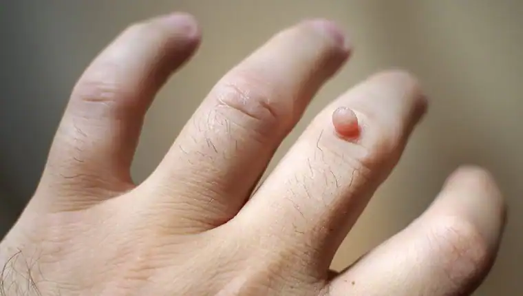 Image of blemish that Cryotherapy Hamilton can remove with Lipo 360.
