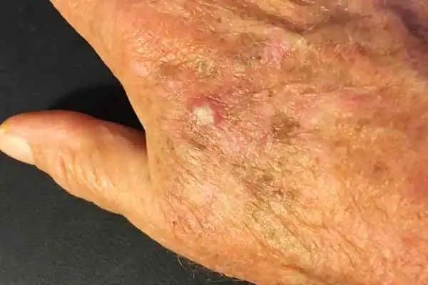 Image of Actinic keratoses Hamilton on a person hand