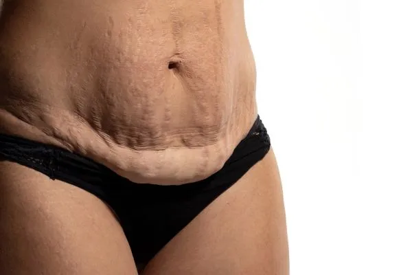 The science behind skin tightening Hamilton picture of a woman's sagging skin on the stomach